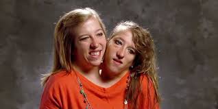 Abby & Brittany Hensel: The Remarkable Journey of Conjoined Twins